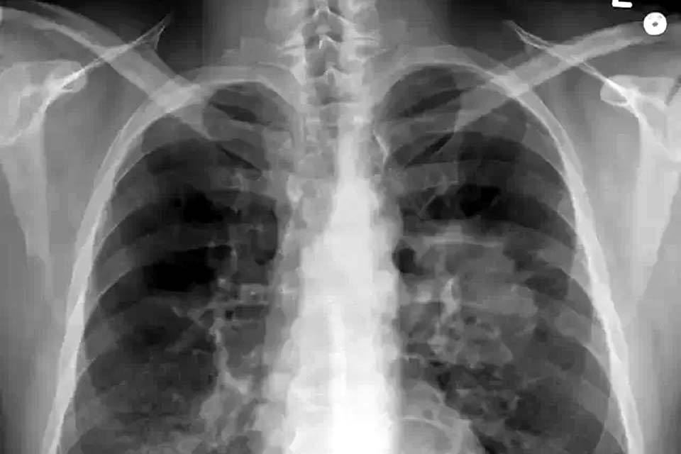 Novo medicamento diminui mortalidade por câncer de pulmão em 51%